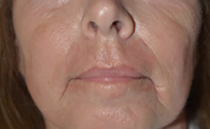 Skin Rejuvenation After