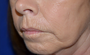 Skin Rejuvenation Before