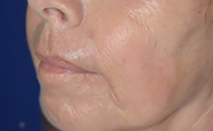 Skin Rejuvenation After